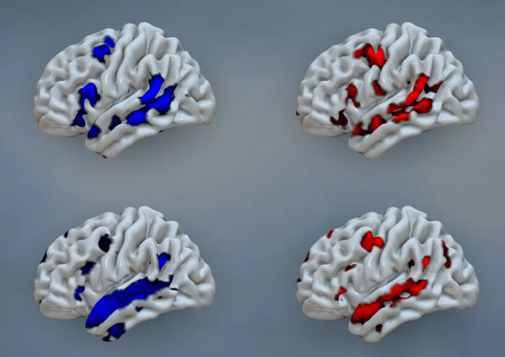 The language networks of two different individuals (top and bottom) were identified using two different methods (left and right). Scans identified the blue networks when the individuals were not performing language-related tasks and the red networks when they read sentences and then nonsense words. This illustrates how the language network can vary between individuals and how it can be identified without having an individual speak, read, or write.