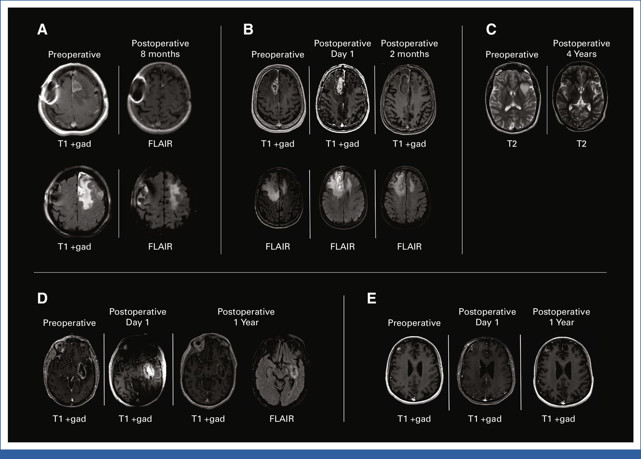 Radiographic changes over time from laser ablation cases of varying pathology.