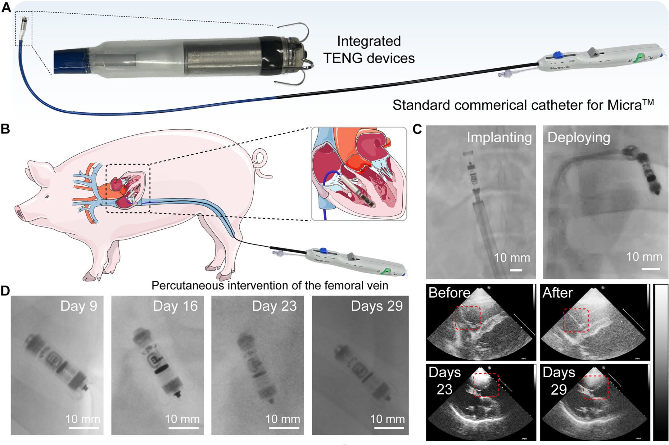 Delivery and implantation of T-LIP with clinical-relevant settings.