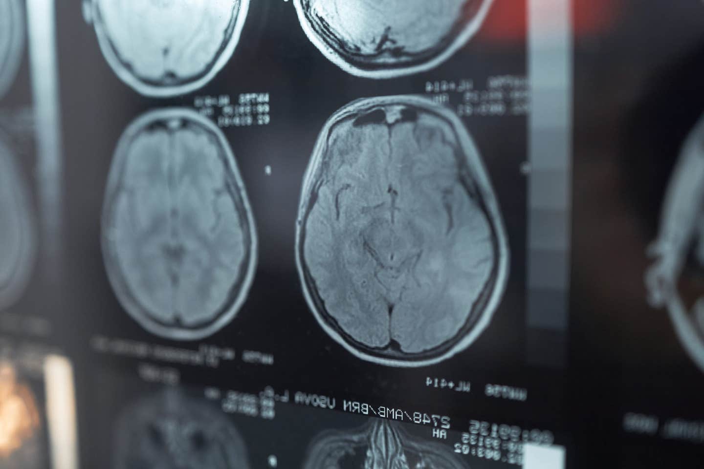 Adult astrocytes stretched, divided, and moved new nuclei into damaged brain regions during a temporary repair state.